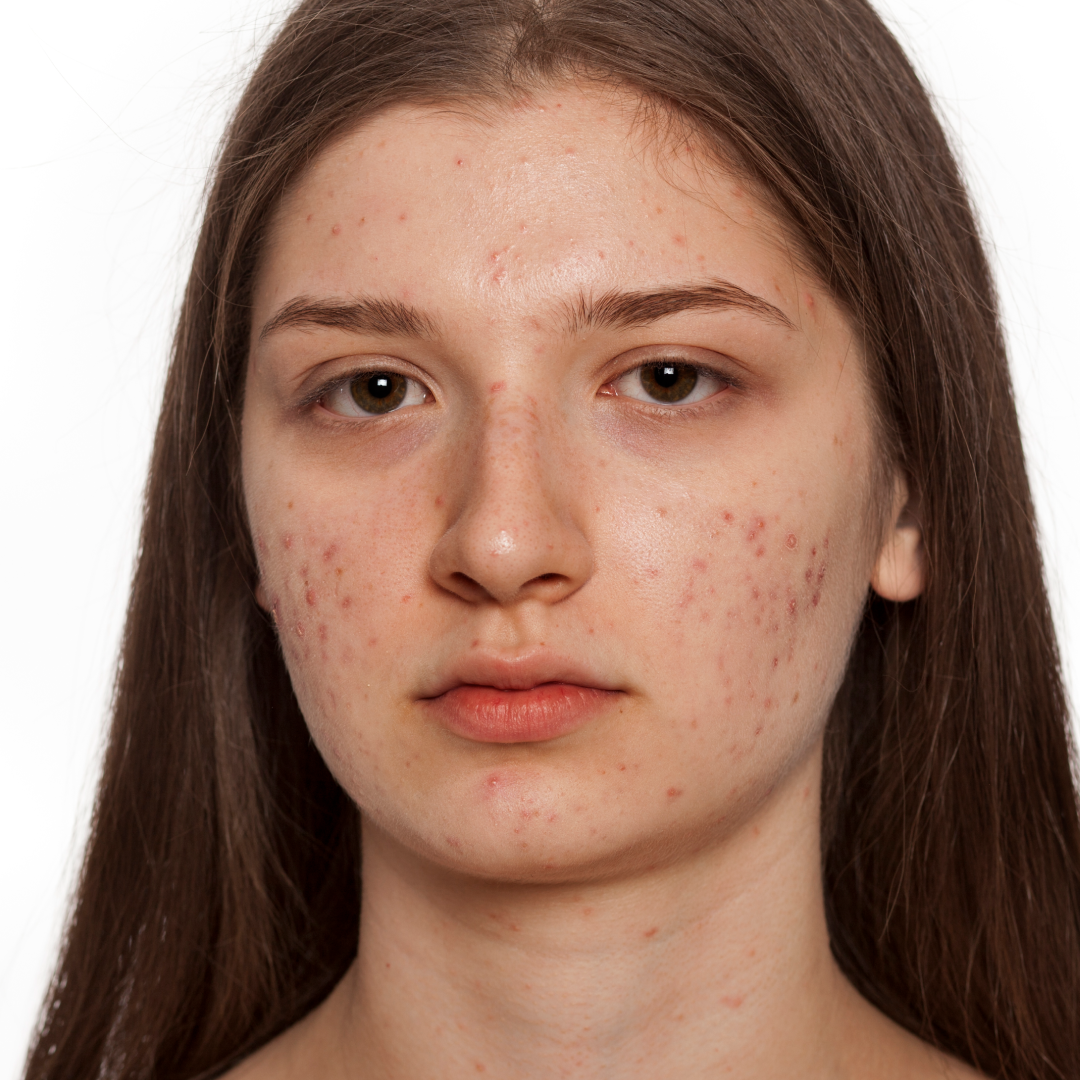 Практические советы по устранению прыщей и поддержанию здоровья кожи